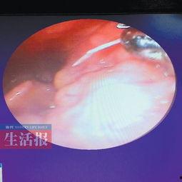 吃白瓜卡喉咙,揭秘夏日清凉美食的甜蜜陷阱